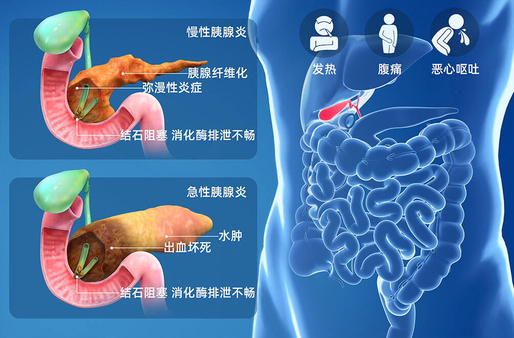 胰腺炎