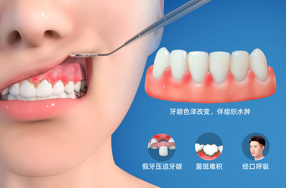 慢性牙龈炎