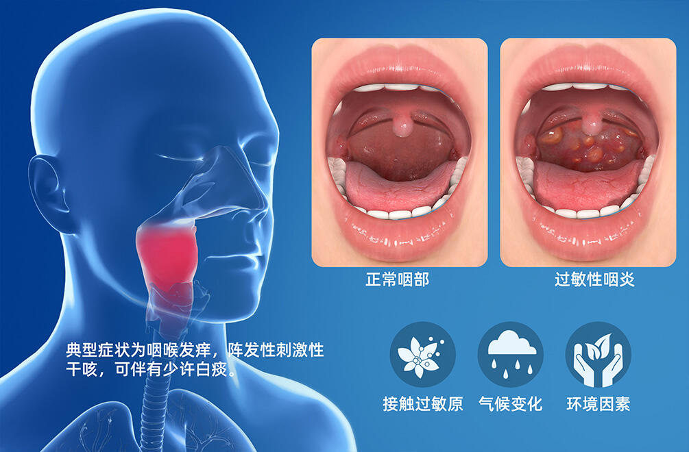 过敏性咽炎