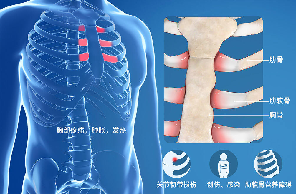 肋软骨炎