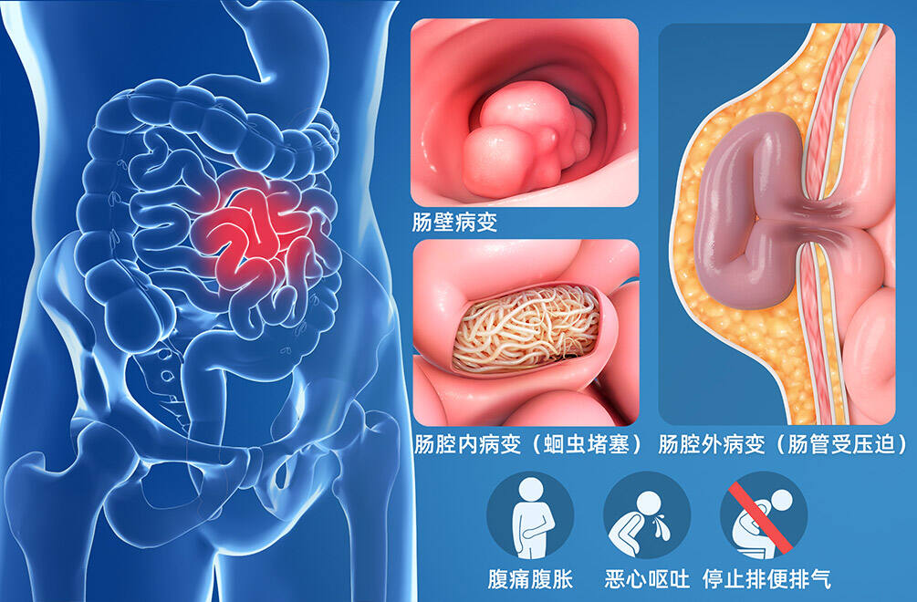 机械性肠梗阻