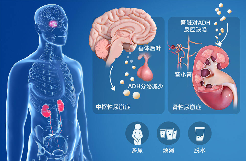 尿崩症