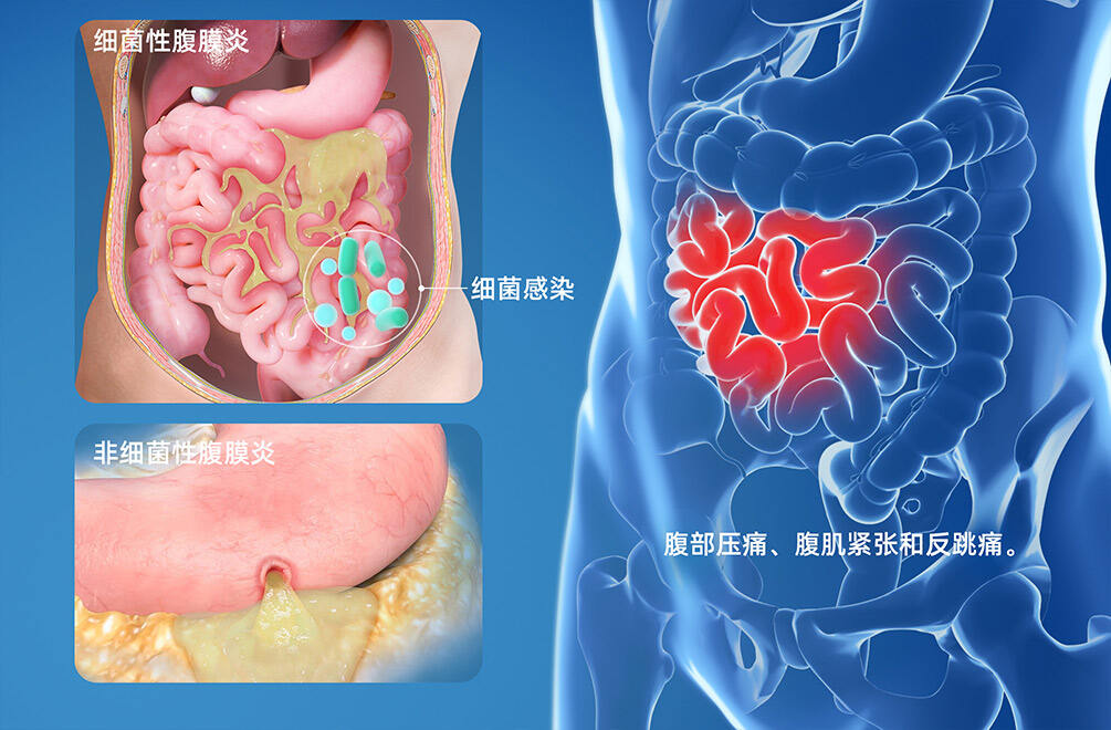 急性腹膜炎