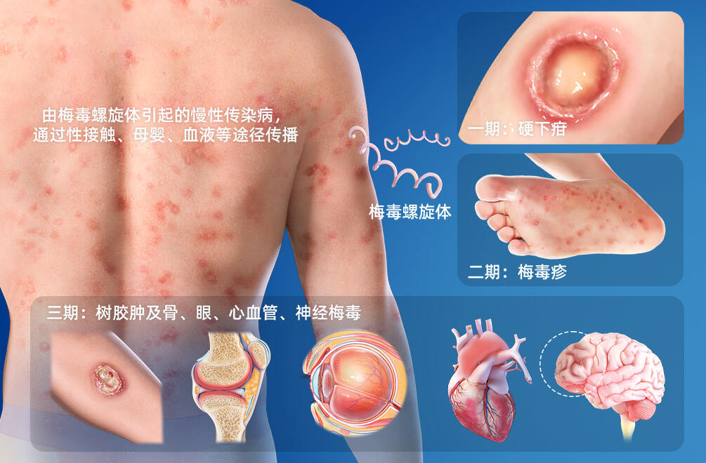 梅毒